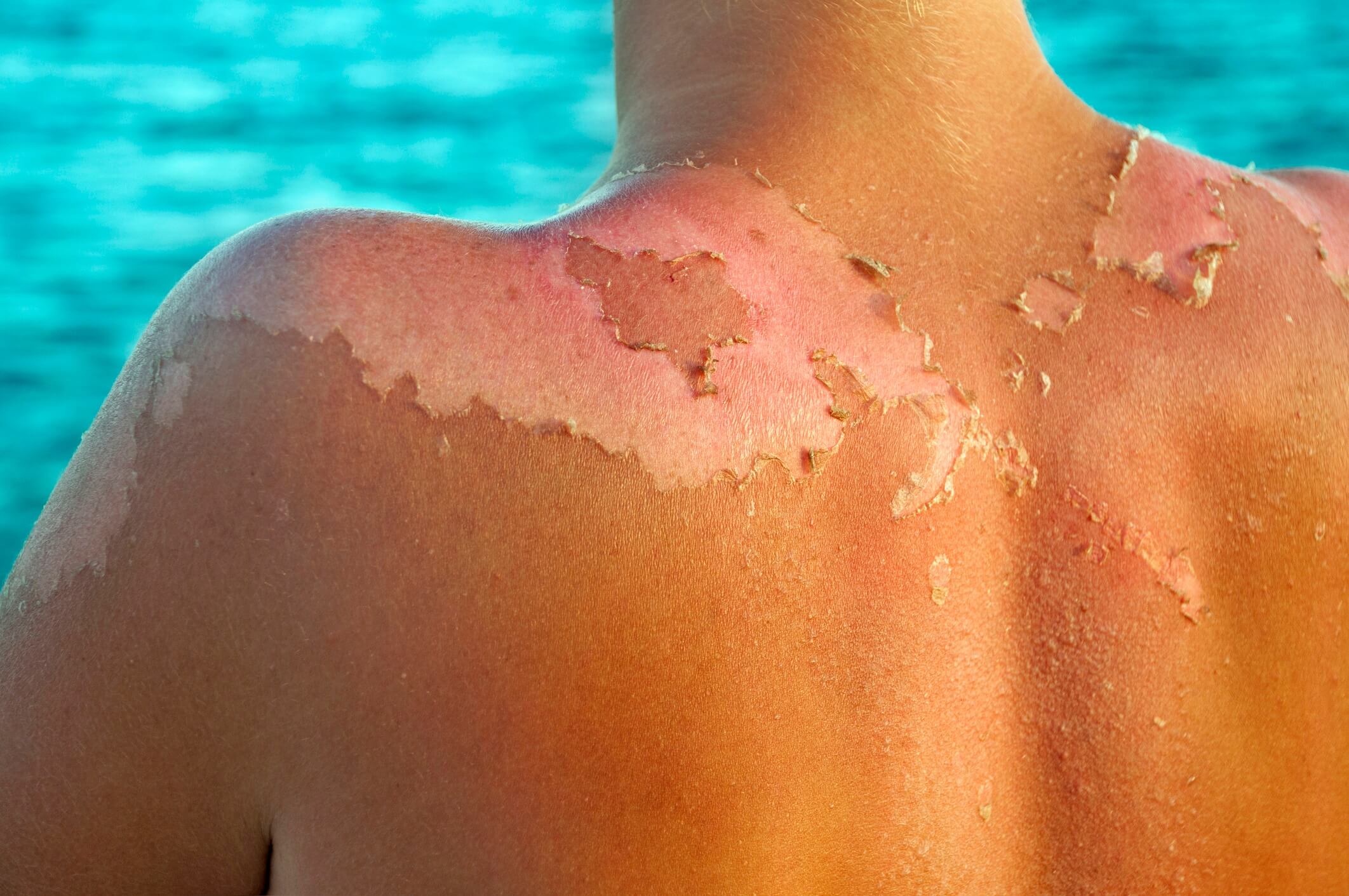 Restores sunburned skin